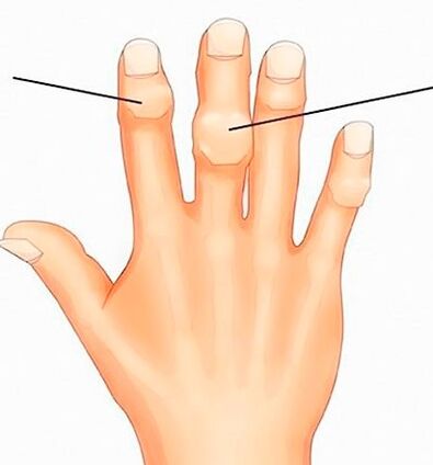 Οι κόμβοι του Heberden και του Bouchard στις μεσοφαλαγγικές αρθρώσεις με αρθρώσεις