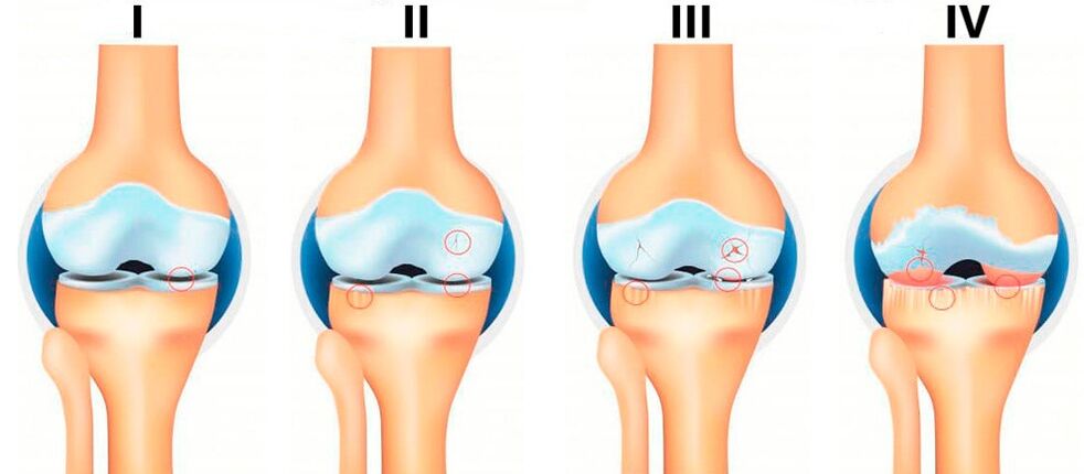 στάδια αρθροπάθειας