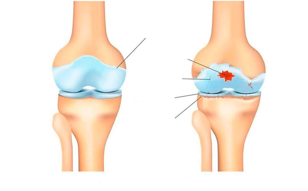υγιής άρθρωση και με αρθρώσεις